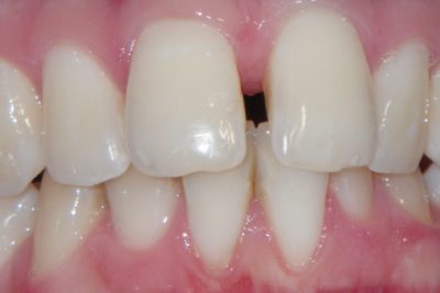 Aparat ortodontyczny 45